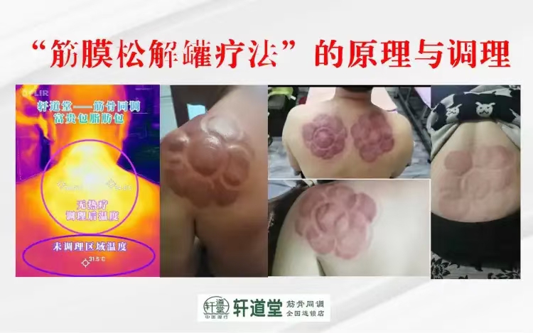 赵鹏飞 “筋膜松解罐疗法”的解剖原理与临床调理 全4讲视频课